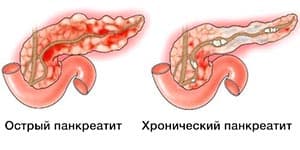 Панкреатит — причины, симптомы и лечение заболевания в клинике «Альфа-Центр Здоровья»